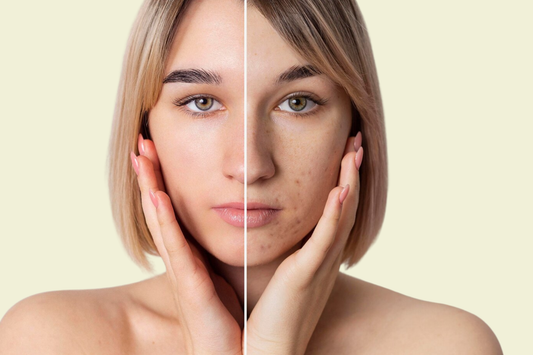 Glikolik Asit, Arbutin, Niacinamide: Bu İçerikler Lekelere Neden Bu Kadar Etkili?